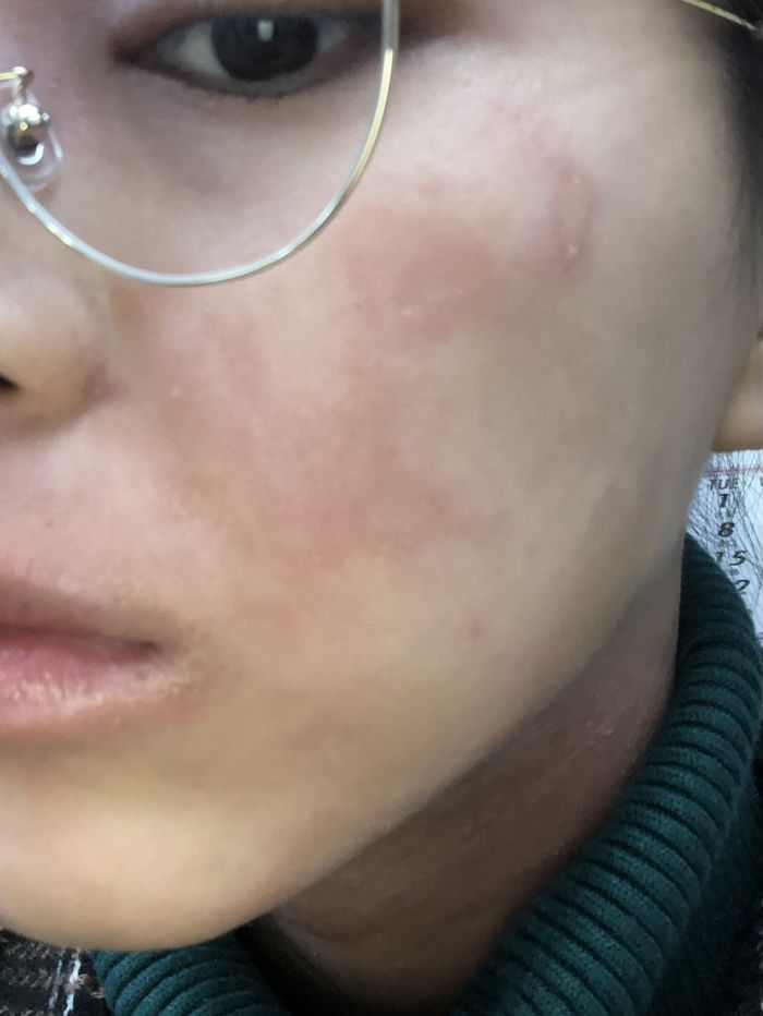 筋トレを始める前は、アトピー肌に悩まされてきた（写真：本人提供）