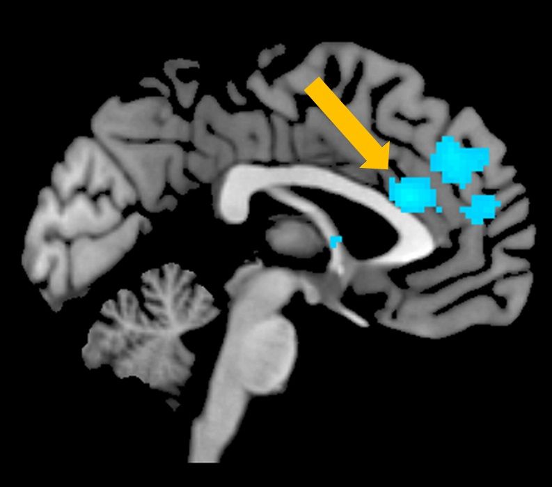 脳の前部帯状回